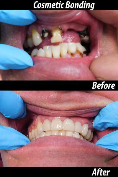 Cosmetic Bonding before and after