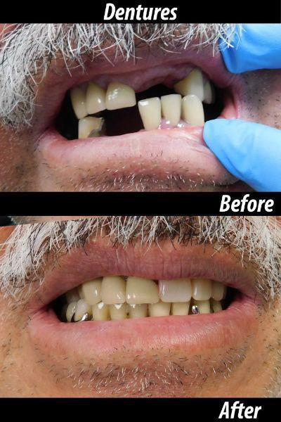 Dentures before and after