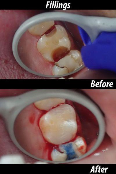 Fillings before and after