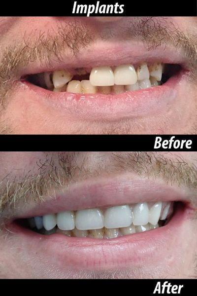 Implants before and after