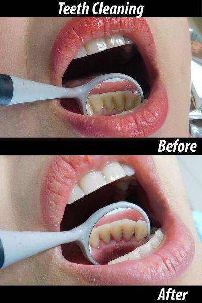 Teeth Cleaning before and after