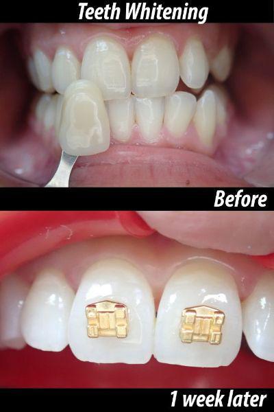 Teeth Whitening before and after — 1 week later