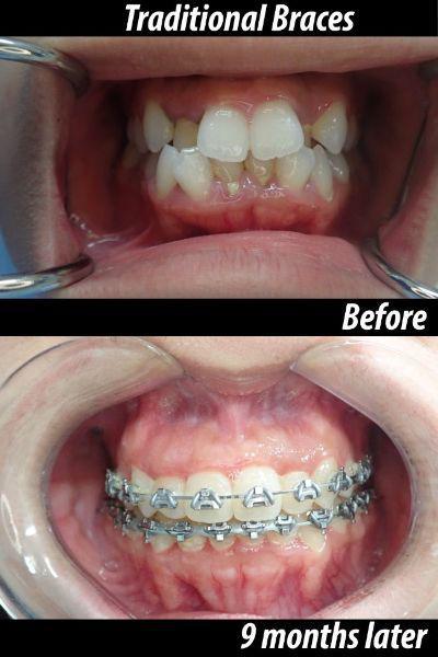 Traditional Braces before and after — 9 months later