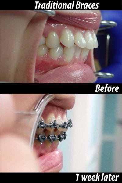 Traditional Braces before and after — 1 week later