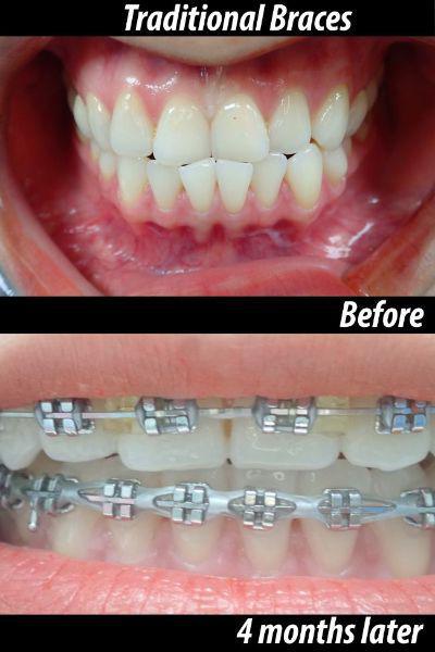 Traditional Braces before and after — 4 months later