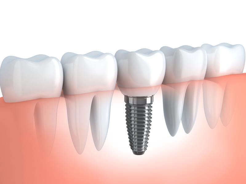 Dental implant model